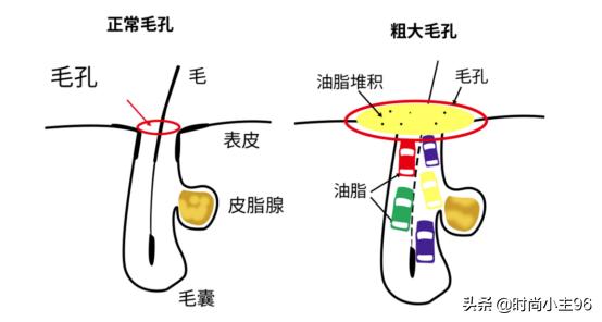 肌肤毛孔粗大出油,油性皮肤毛孔大怎么办