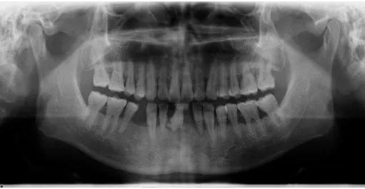 中年牙齿松什么原因,中老年人牙齿松最佳补救方法