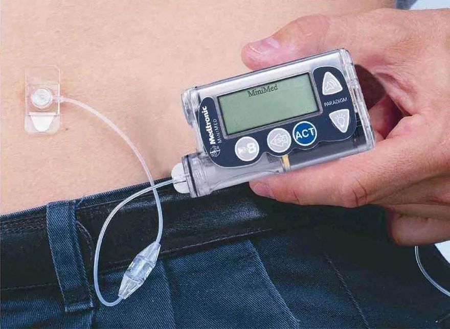 佩戴胰岛素泵如何平稳血糖,糖友怎么自己打针