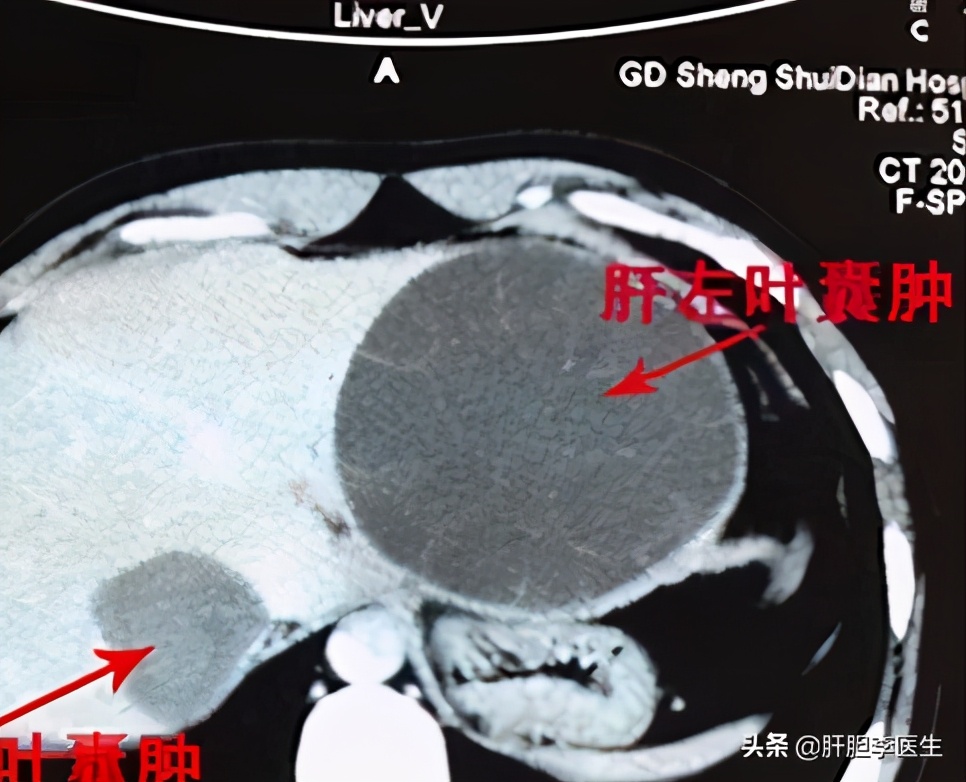 体检有肝囊肿要不要治疗,体检有肝囊肿需怎样解决