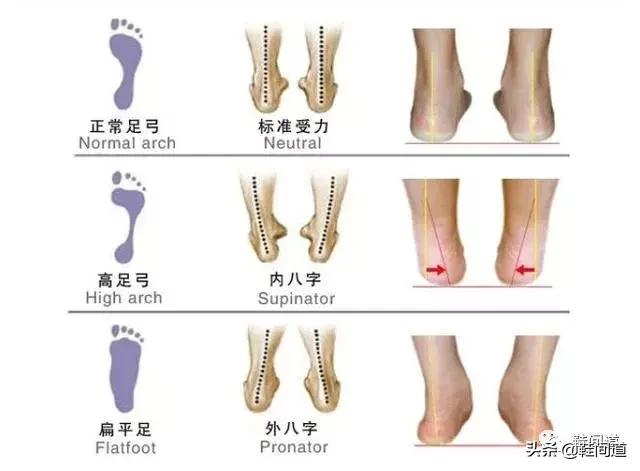 足弓对人体的影响｜脚型对鞋子的要求（附：选购建议）