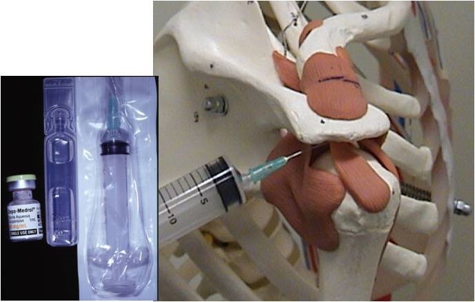 肩袖损伤要怎么处理,肩袖损伤专用膏药