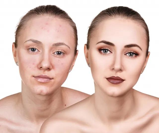 学生党祛痘印最快方法,什么东西祛痘印最快最有效