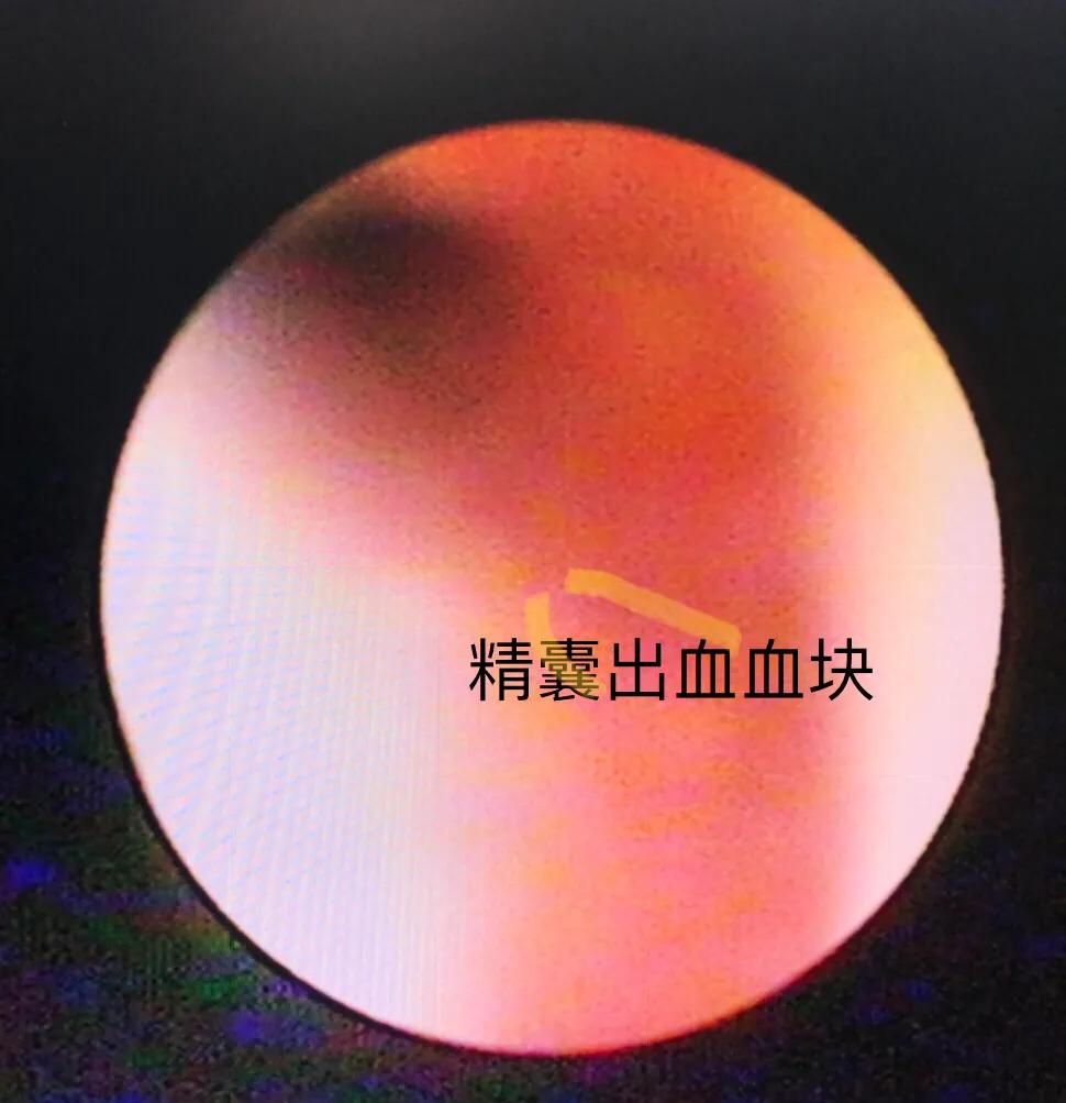 精囊结石精囊镜,精囊镜与钬激光手术