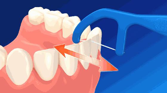 牙周炎塞牙吃什么,牙周炎导致塞牙