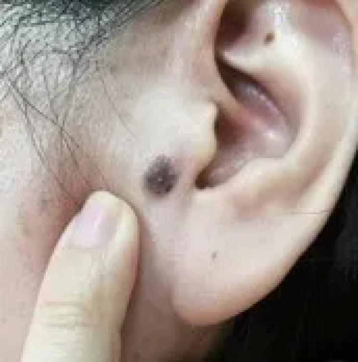 哪些部位长痣预示一生劳碌,痣的位置预示着什么