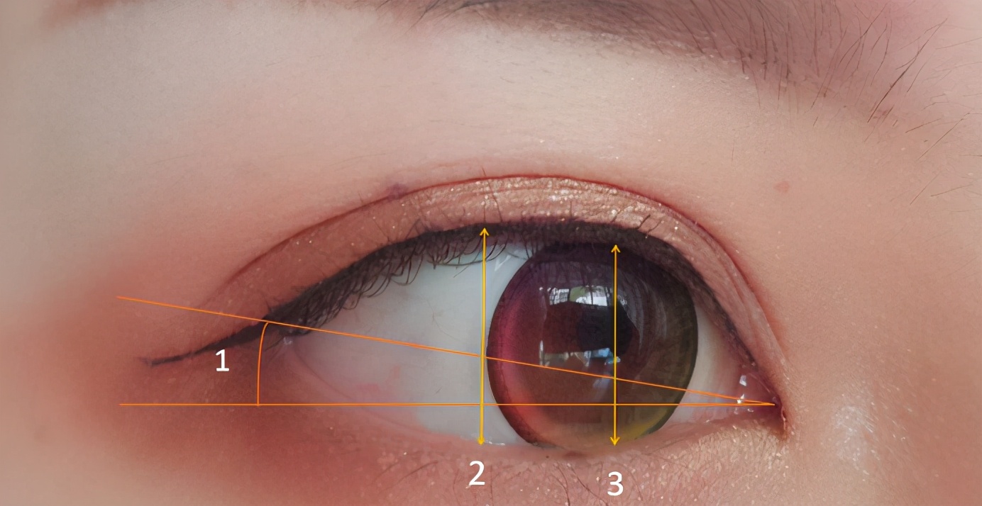 关于下睑下至，到底做还是不做？美之峰解灿告诉你