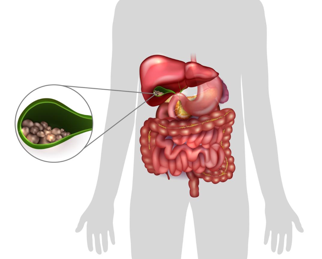 高盐食物缺钙,少吃盐会不会缺钙