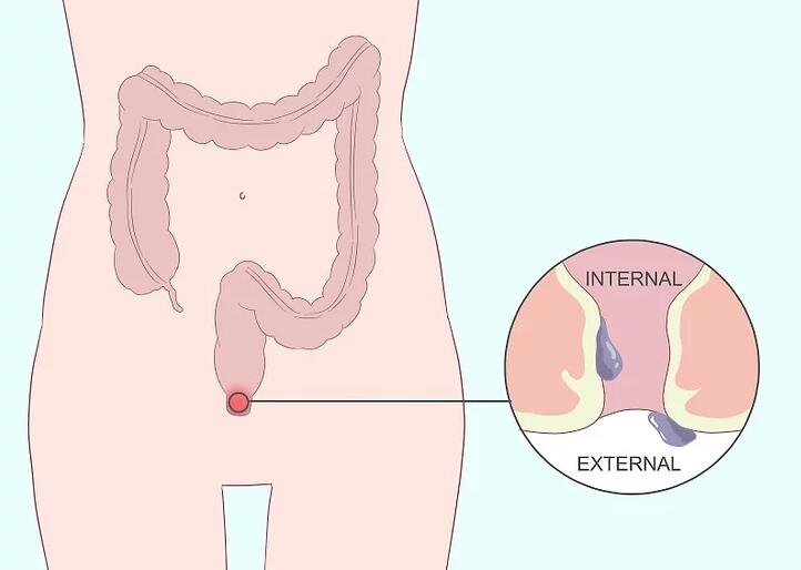 得了痔疮怎么办学会三招治痔疮,得了痔疮别担心这个小方法快试试