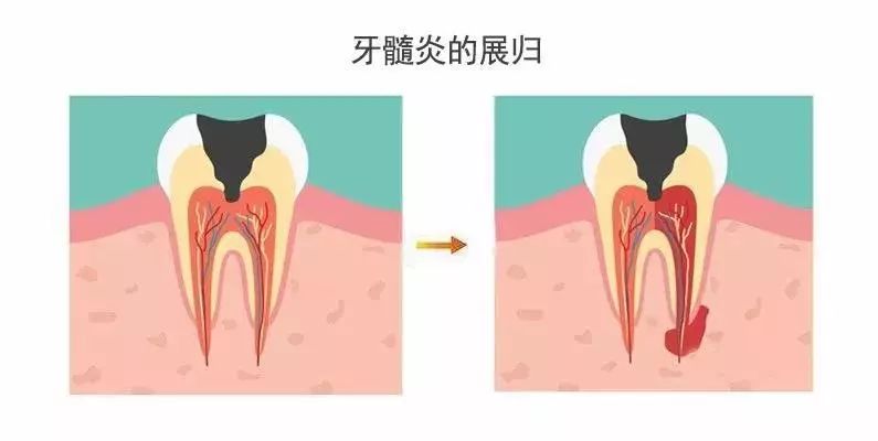 什么是牙髓炎牙髓炎可以自愈吗,什么是牙髓炎要根治吗
