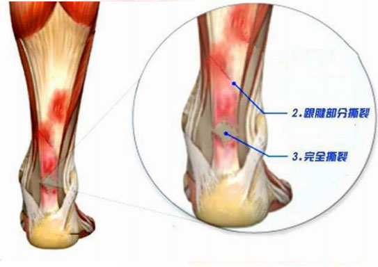 运动员筋受伤,运动员腰和腿都受伤