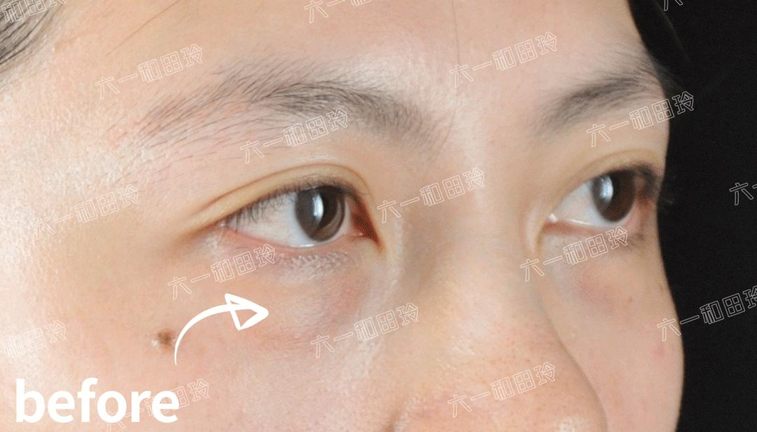 带娃长期熬夜的眼袋怎么去除,女人35岁以后一熬夜眼袋深怎么办