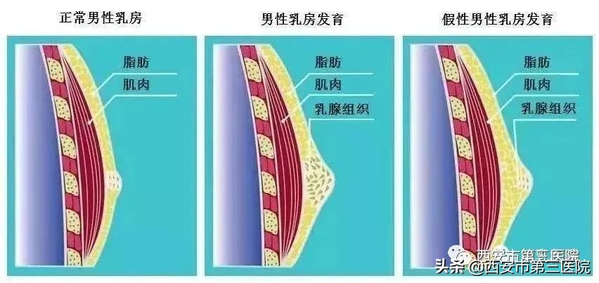 男性乳房发育太快怎么解决,男性吃黄体酮多久乳房发育