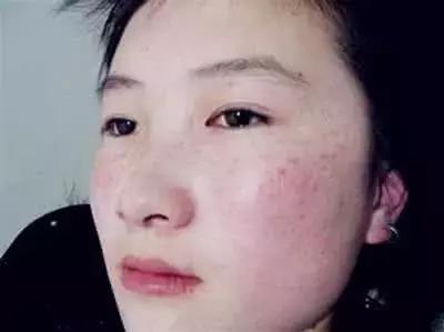 祛斑面诊必背知识点,要祛斑