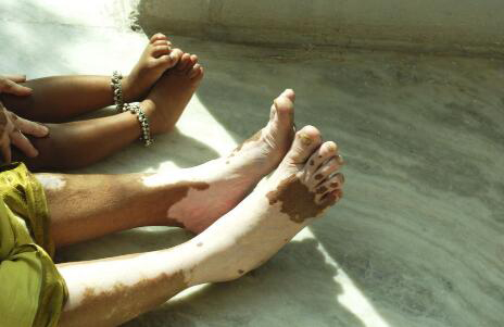 长了白斑怎么治疗,脚上长白斑是怎么回事