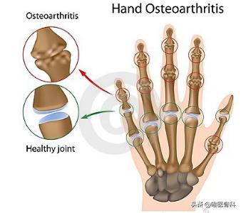 手指僵硬骨关节炎的治疗,手指关节肿大是骨关节炎能治好吗