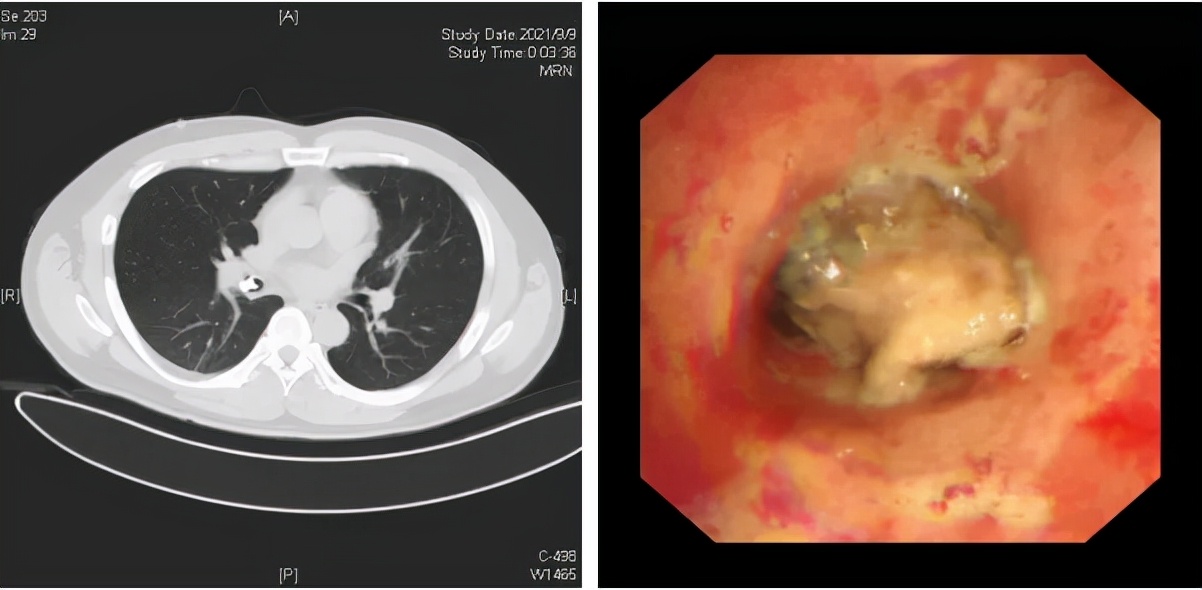 气管呛入异物最佳处理方法,呛住气管异物怎么自救