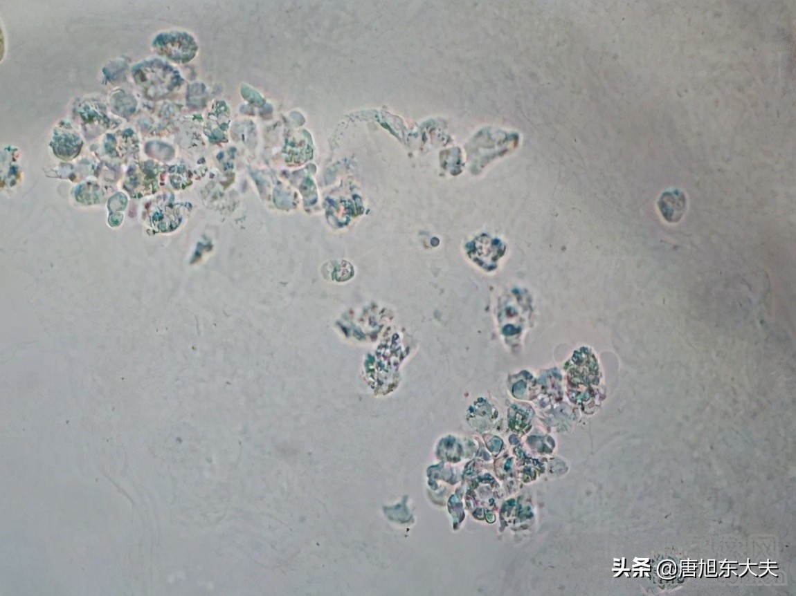 再生障碍性贫血经常输血能活多久,再生障碍性贫血一直输血能活多久