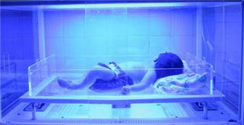 孩子出生后黄疸是怎么回事,孩子出生后变得很黄是为什么