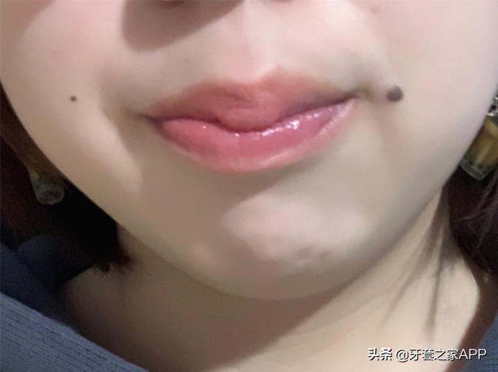 不靠整容怎么改变下巴后缩?看这里