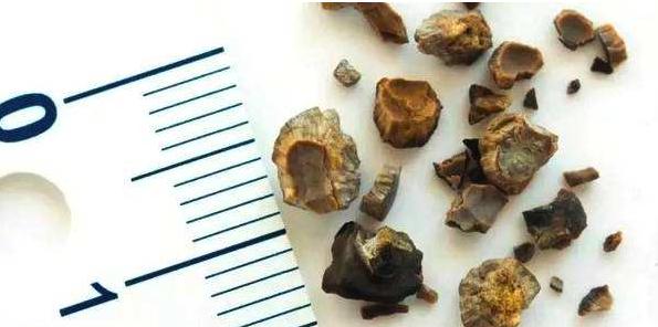 微创胆囊切除手术后便秘怎么办,胆囊切除术后便秘可以吃泻药吗