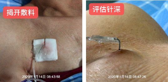 输液港不回血但输液通畅怎么办,输液港维护没有回血怎么回事