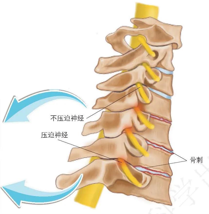 颈椎生理曲度变直有骨刺怎么办,颈椎x线片能看到什么吗