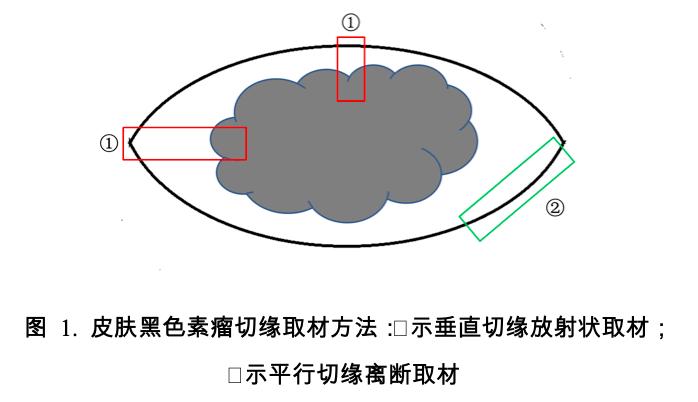 黑色素瘤指南最新,2019黑色素瘤诊疗指南
