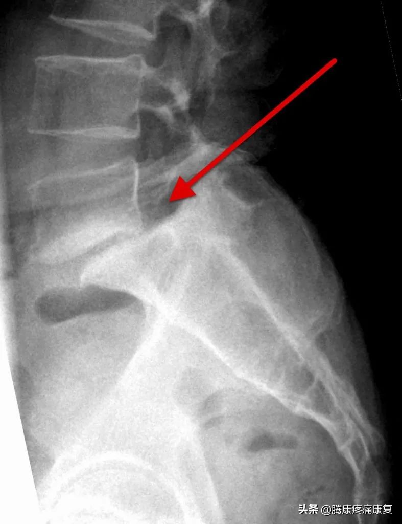 腰椎滑脱的治疗与锻炼图片,腰椎滑脱的治疗与锻炼