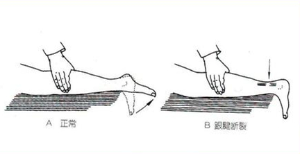 跟腱断裂轻度功能障碍鉴定标准,跟腱出现问题前有什么表现