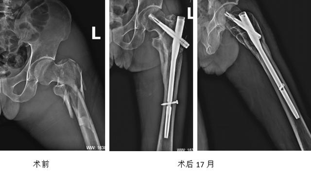 髋部骨折危害大老年人摔伤要重视,髋部骨折的最简单方法