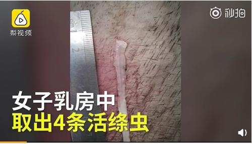 小孩眼睛里长阴虱,4岁小孩睫毛长满阴虱瘙痒难忍