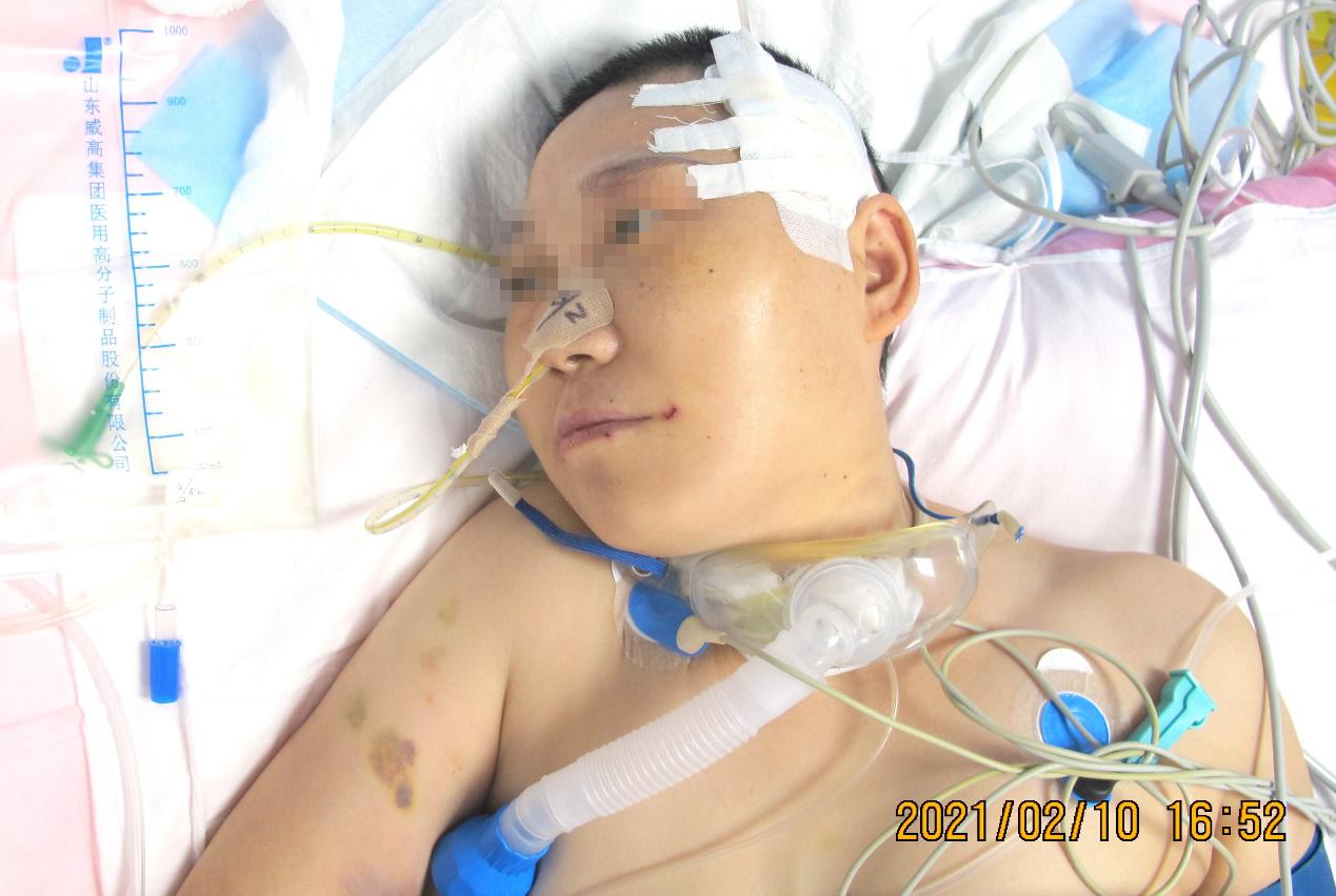 脑脓肿合并脑膜炎需要手术吗,脑脓肿进入左侧脑室严重吗