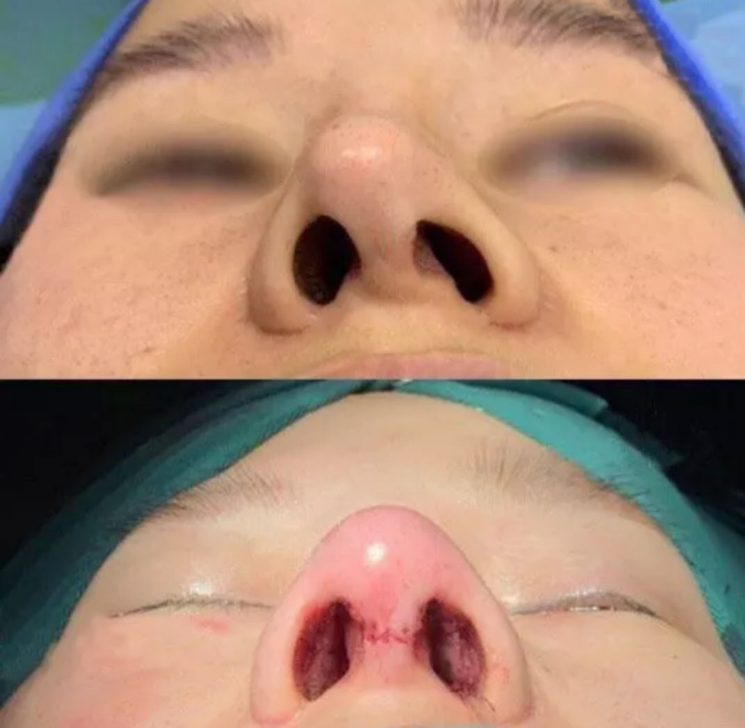 余文林鼻子修复方法,余文林修复嘴唇怎么样