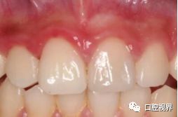 门牙受伤怎么办,门牙撞断了怎么办