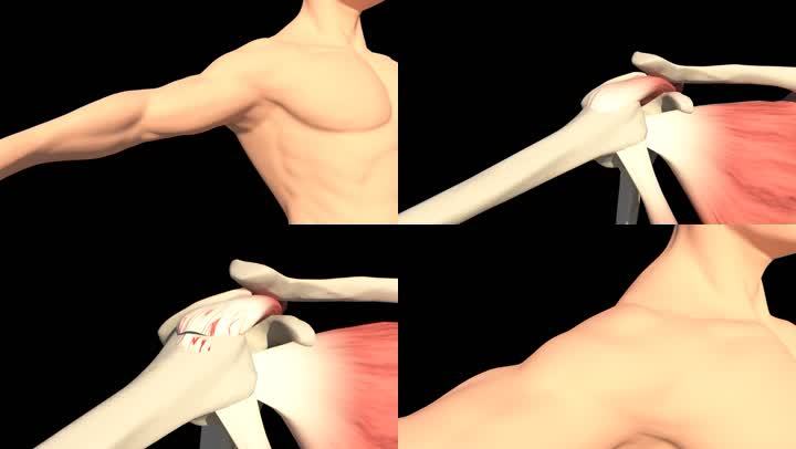 肩袖损伤临床诊断,肩袖损伤病因学