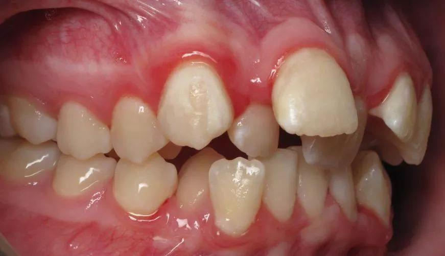 牙套要不要戴久一点再摘,牙套戴多久才不刮嘴