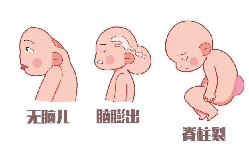 成人发现先天性脊柱裂怎么办,警惕脊柱裂图片