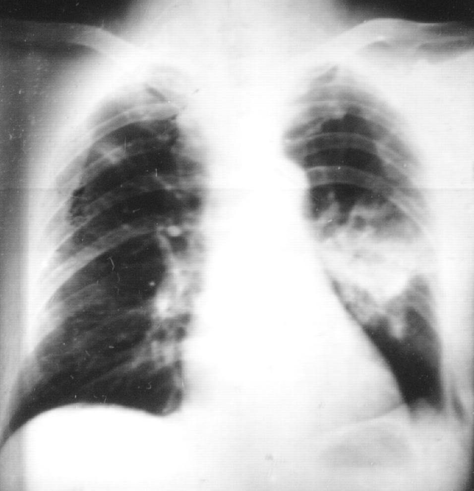 肺结核防控诊疗方案,成功治疗肺结核病的关键