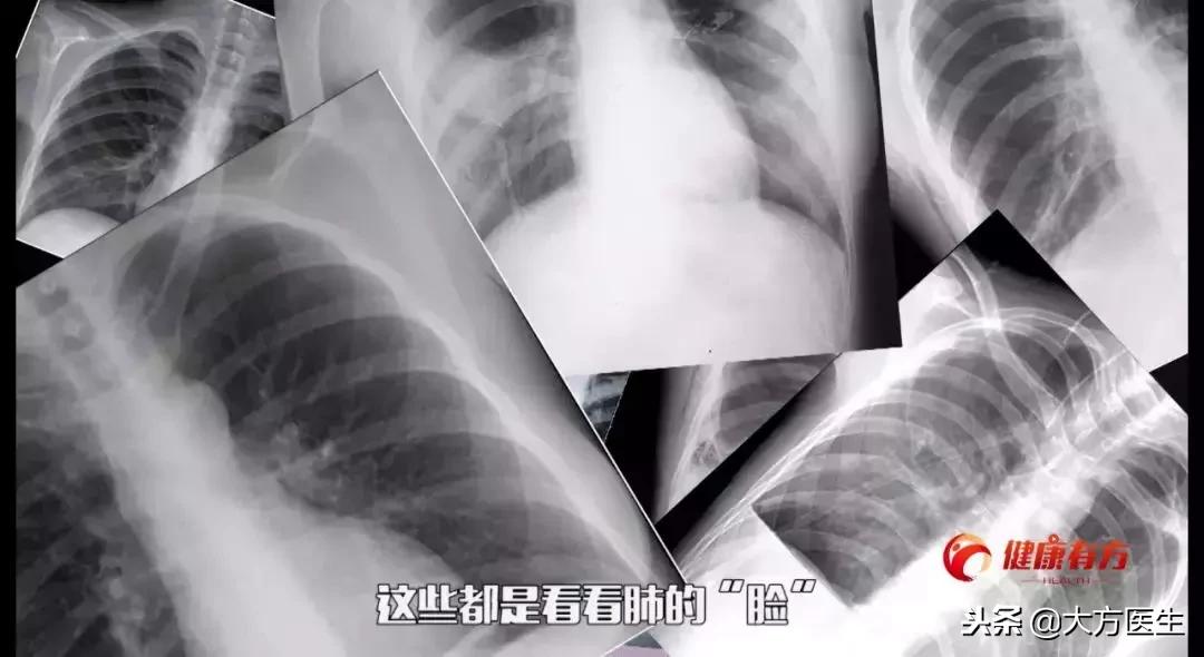 胸片没事排除肺病吗,胸片没事是不是可以排除肺炎