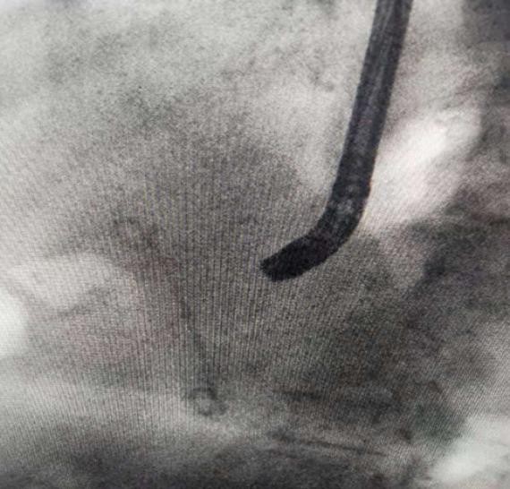 精益求精镜亦求净哈医大一院消化内科ERCP下取净胆管内2.5cm巨型结石