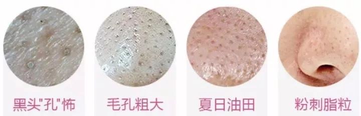 脸部黑头粉刺的最佳去除方法,脸上黑头粉刺用什么办法快速解决