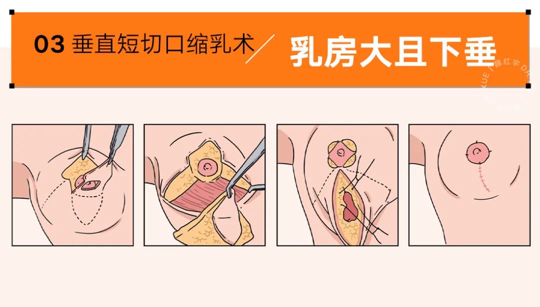 乳房缩小整形适合人群,乳房缩小术可能造成的并发症