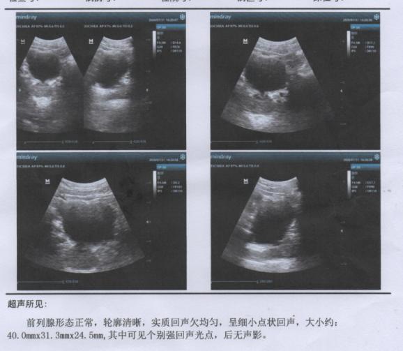 慢性前列腺炎治疗效果差有哪些原因?看看这位患者是怎么痊愈的