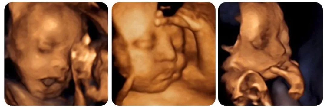 37周做四维彩超有必要吗,孕期四维彩超有必要做吗