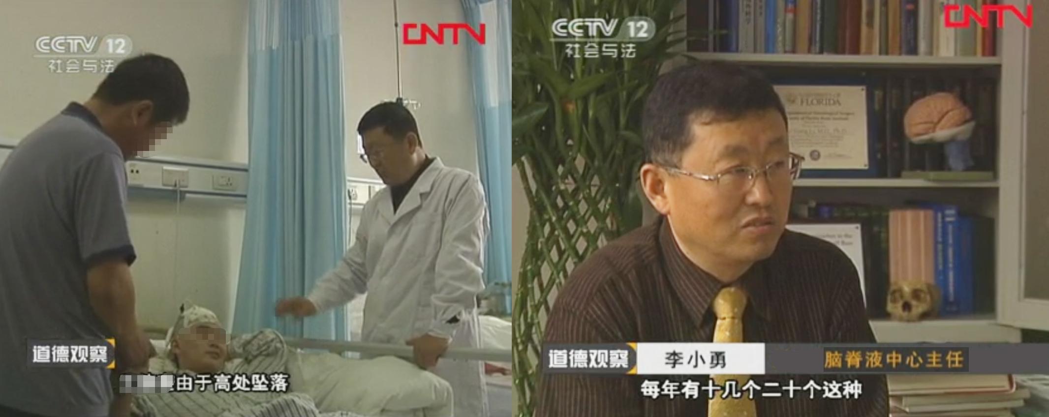 脑受伤开颅手术昏迷,开颅手术后20天发生脑积水引流