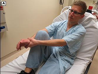 肩膀脱臼自己复位步骤视频,肩膀脱臼怎么自我复位视频