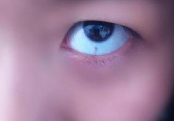 孩子眼睛眼白处有灰黑点,孩子眼睛眼白有黑斑咋回事