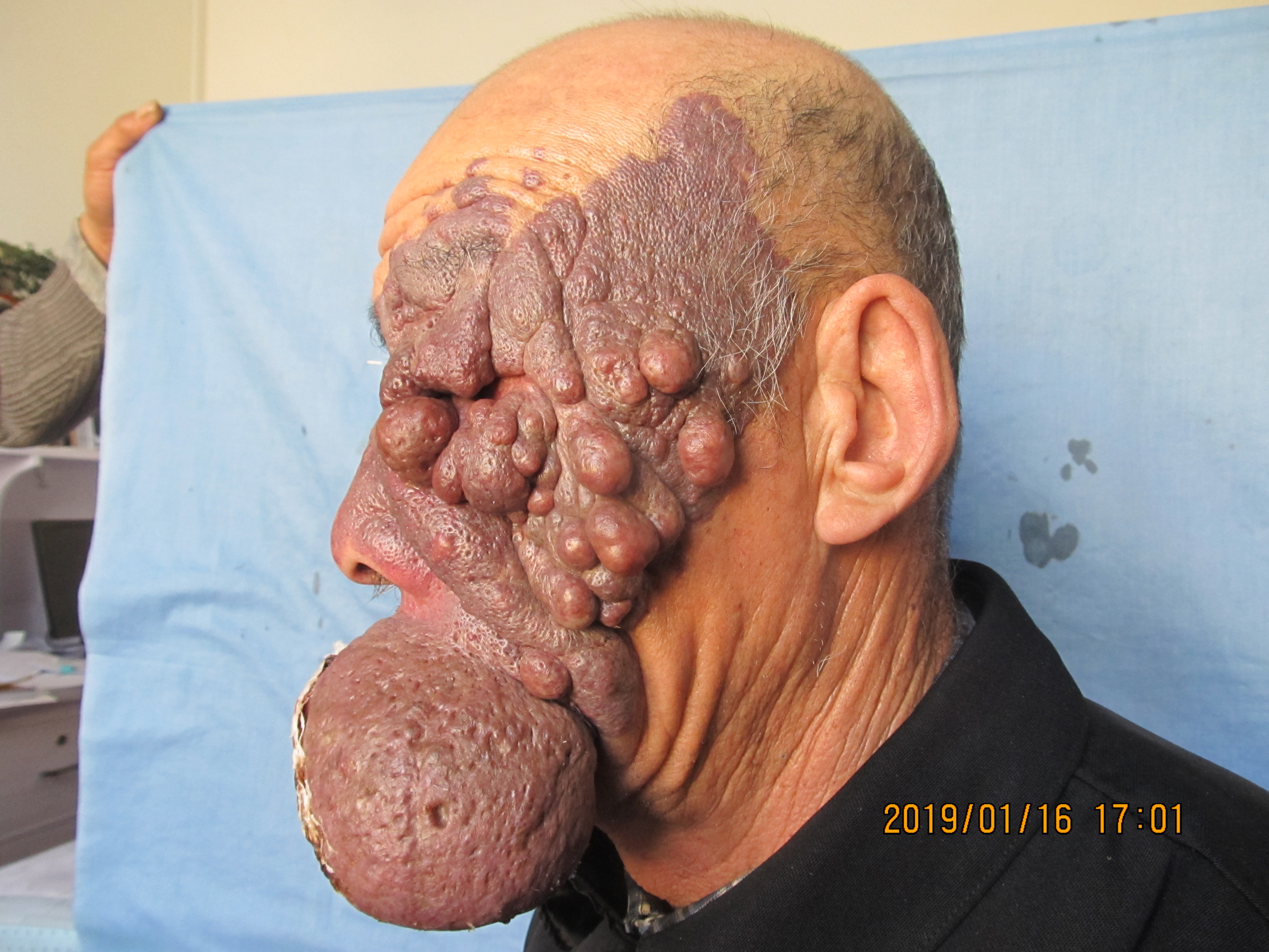 胎记变成恶性肿瘤会治好吗,天生的黑色胎记会癌变吗