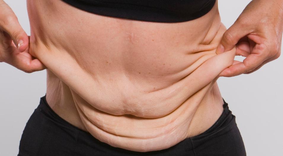 胖子减肥后皮肤松弛自己会修复吗,减肥皮肤松弛怎样让皮肤变紧致